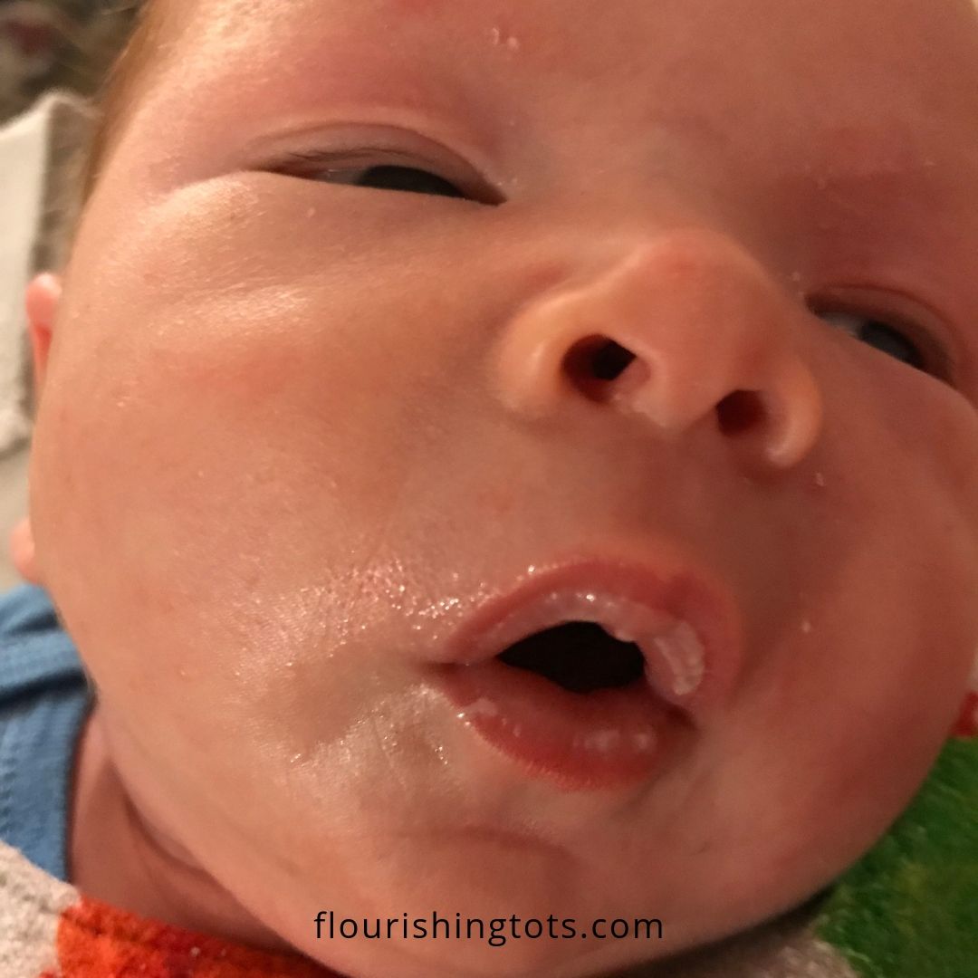 Thrush on babies lips deals